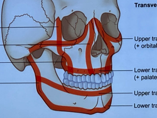 Corps Anchorage: Remote Anchorage for the Atrophic Arch + Advanced Cadaver Lab