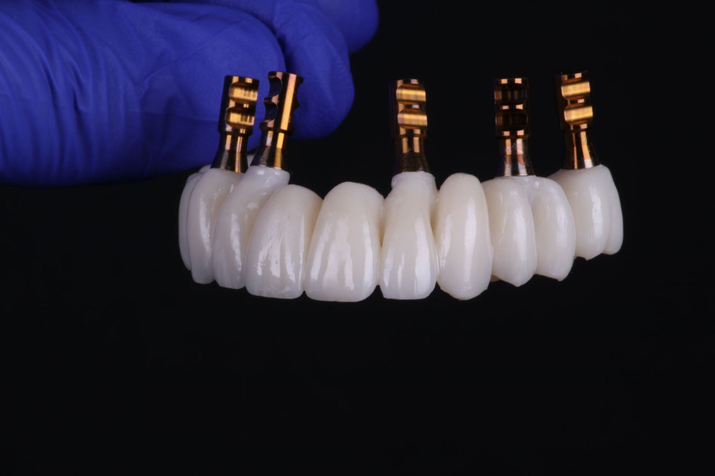 Corps Preservation: FP1 Full Arch Immediate